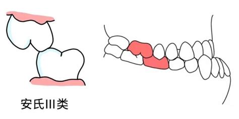 反頜意思|反頜患者必看：最新療法